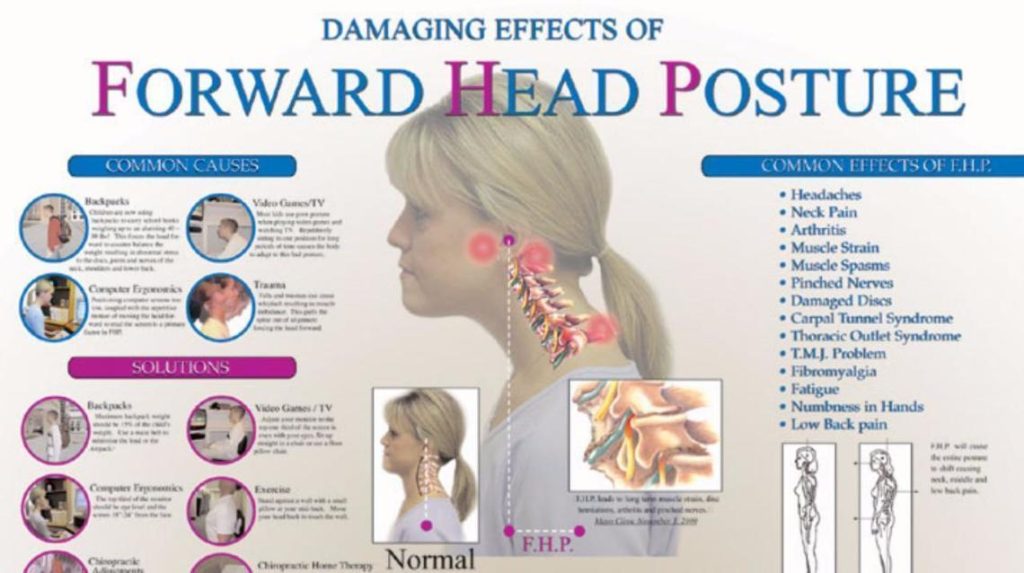 Correcting Nerd Neck: Effective Solutions for Better Posture